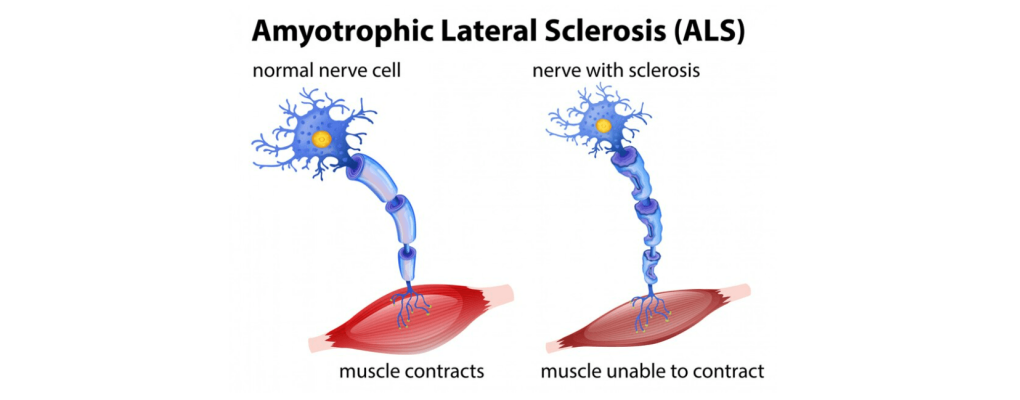 Amiyotrofik Lateral Skleroz (ALS/MND)