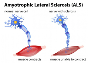 Amiyotrofik Lateral Skleroz (ALS/MND)