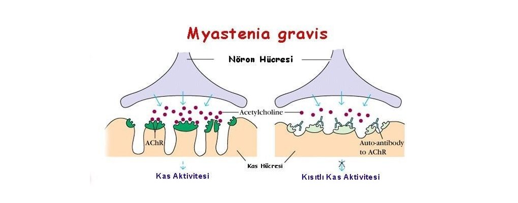 Myestania Gravis (MG)
