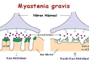 Myestania Gravis (MG)